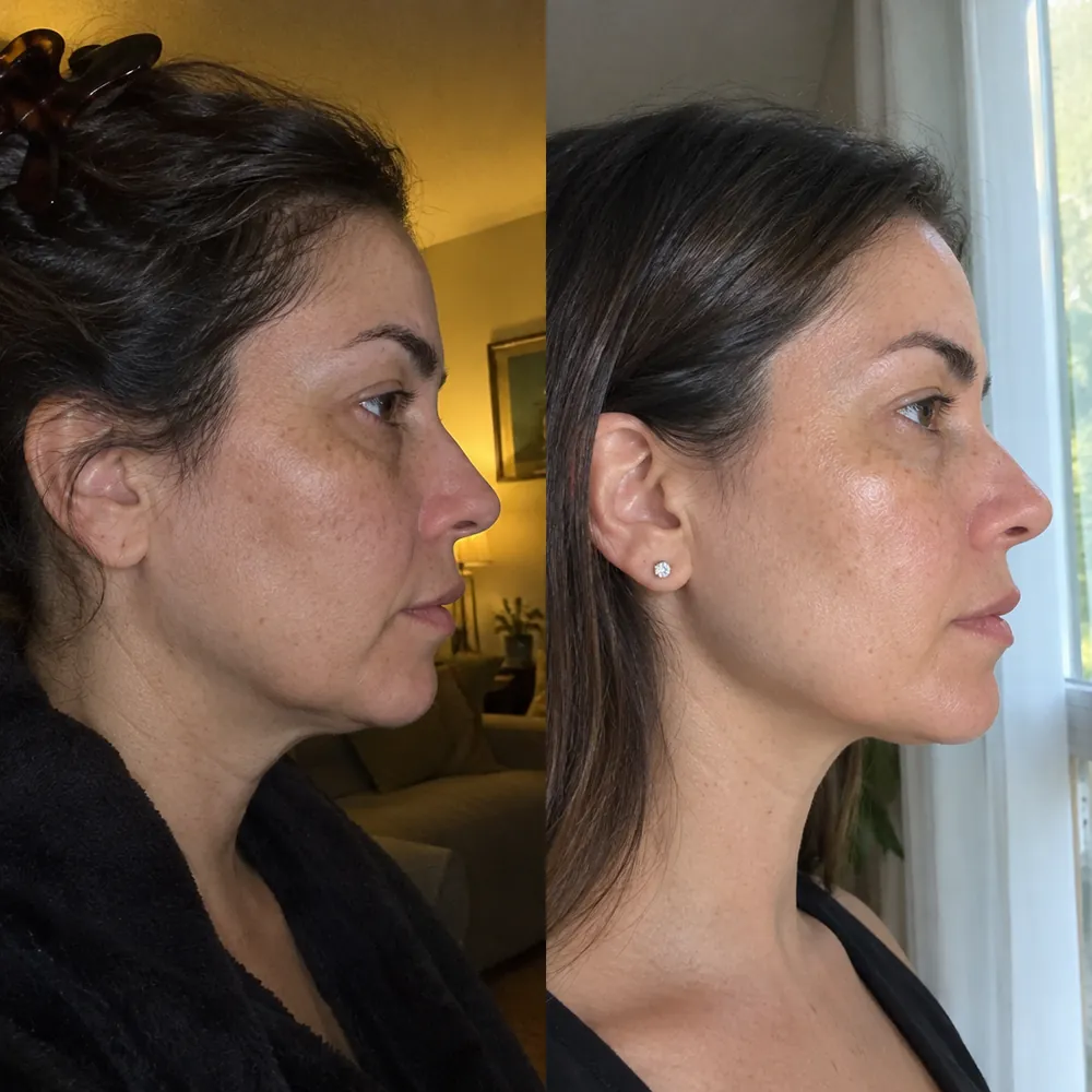 Antes e depois: contorno com aparência mais firme